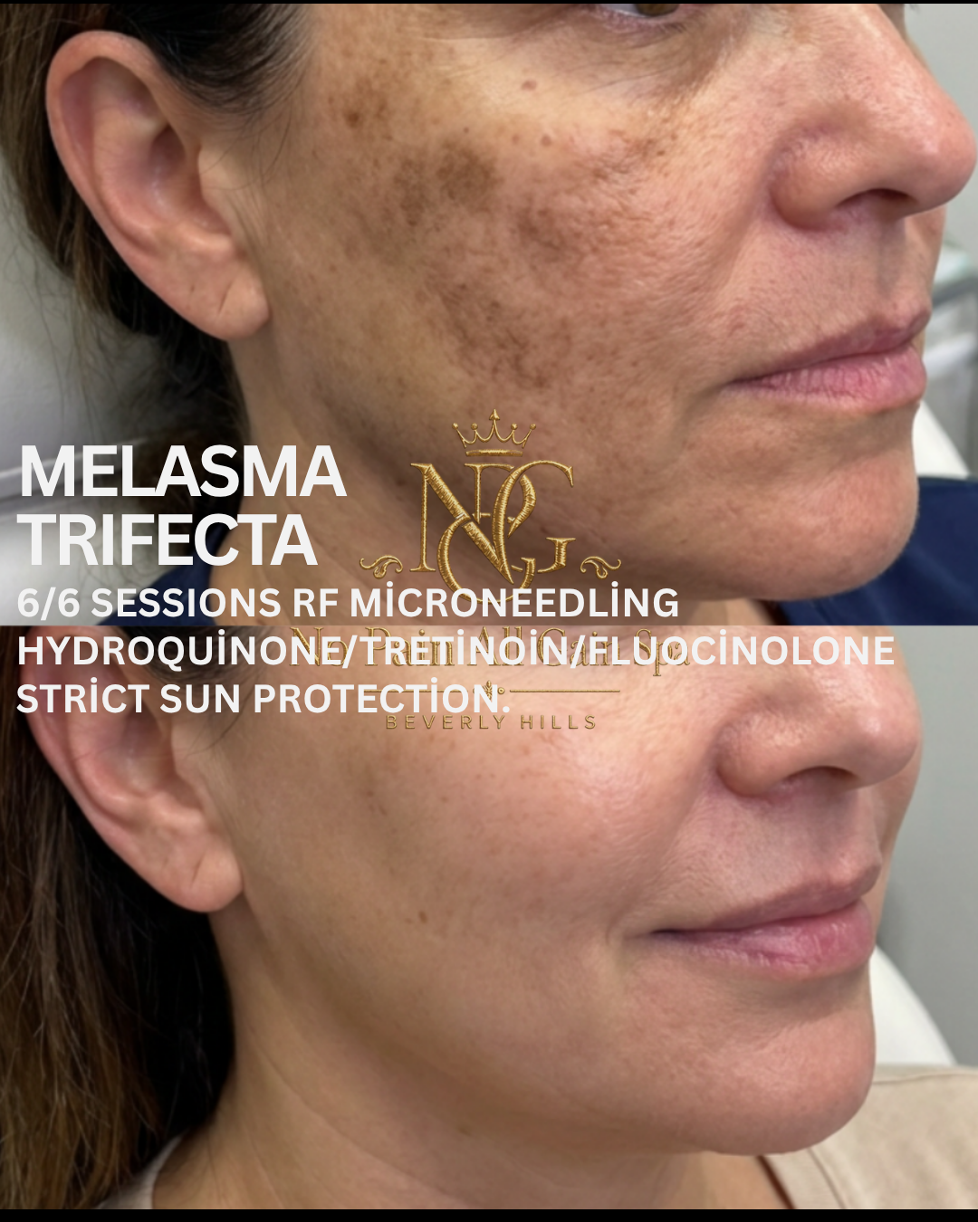 Before and after images showing the removal of melasma hyperpigmentation on a woman's face following micro-needling treatments.