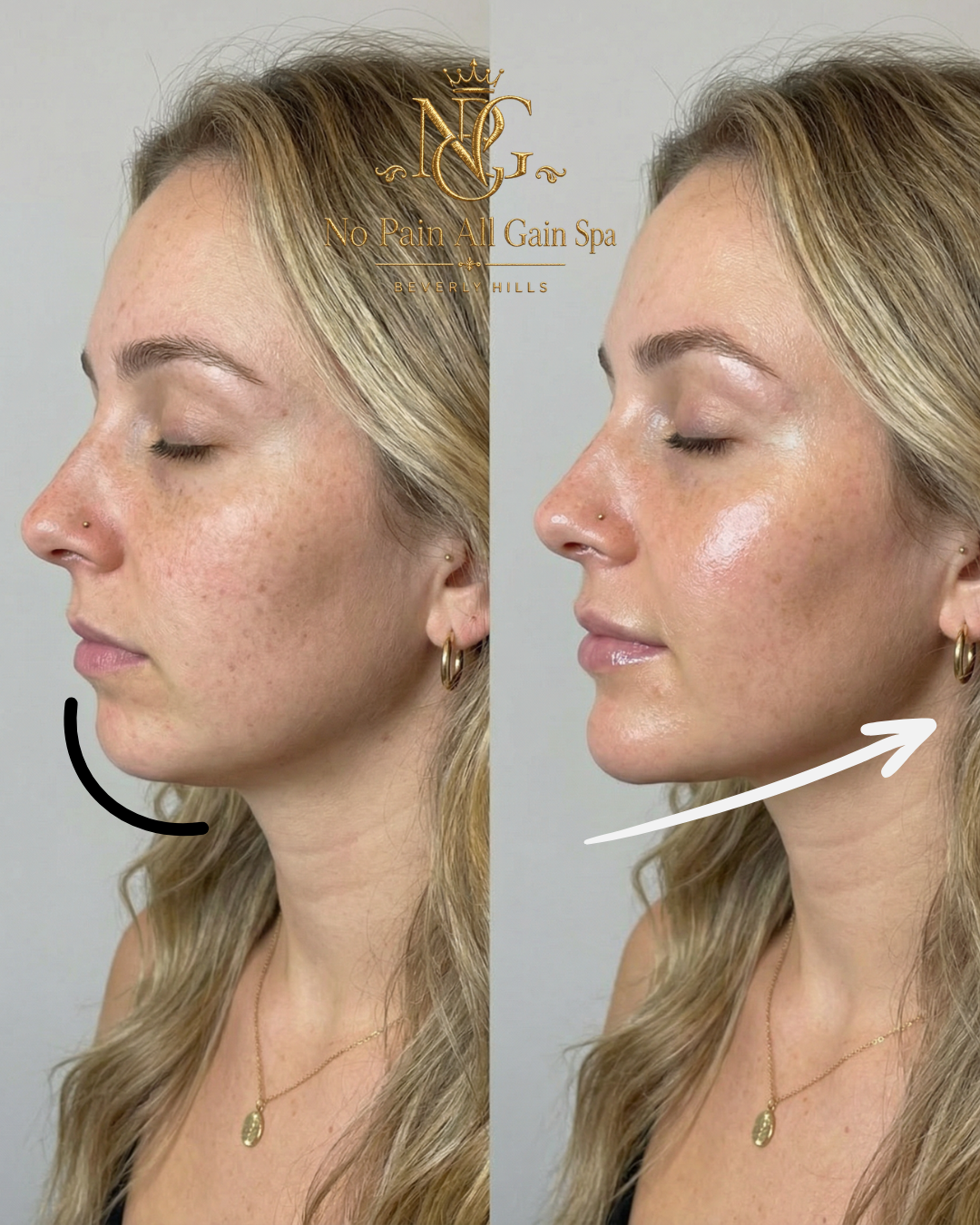 Side-by-side comparison of a woman's face showing before and after acne treatment at No Pain All Gain Spa, Beverly Hills. The left image shows her with acne scars, the right image shows her with clearer, smoother skin.