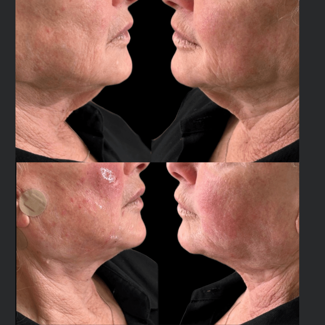 Close-up comparison of a woman’s face before and after a skincare or cosmetic treatment, showing improvements in skin texture and reduction of redness.