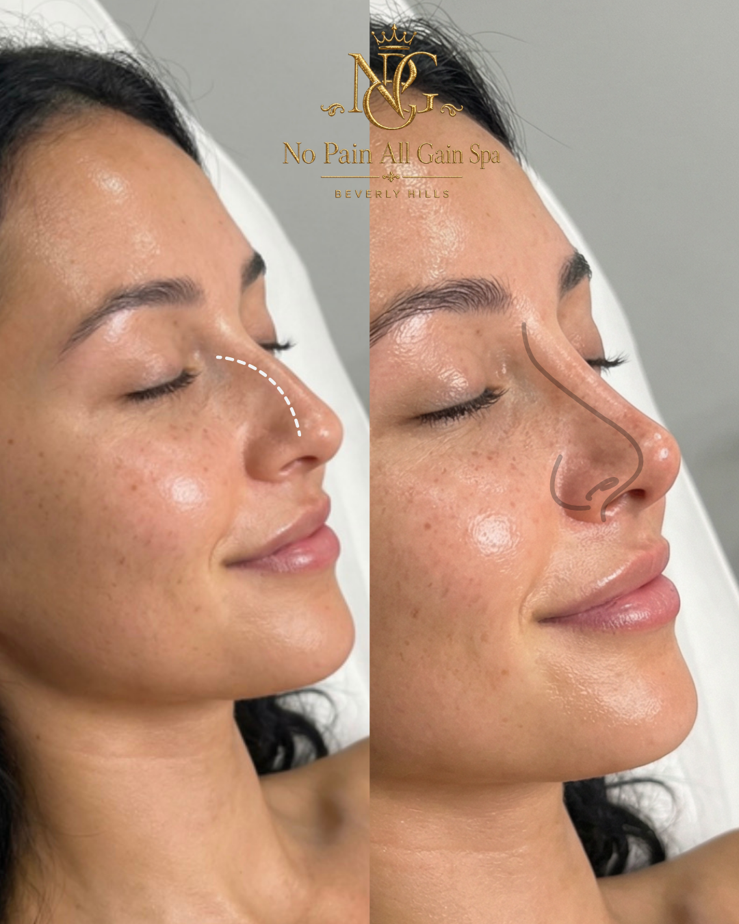Side-by-side before and after images of a woman showing a rhinoplasty or nose reshaping procedure at No Pain All Gain Spa in Beverly Hills.
