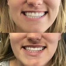 Close-up of a person's smiling mouth showing white teeth.