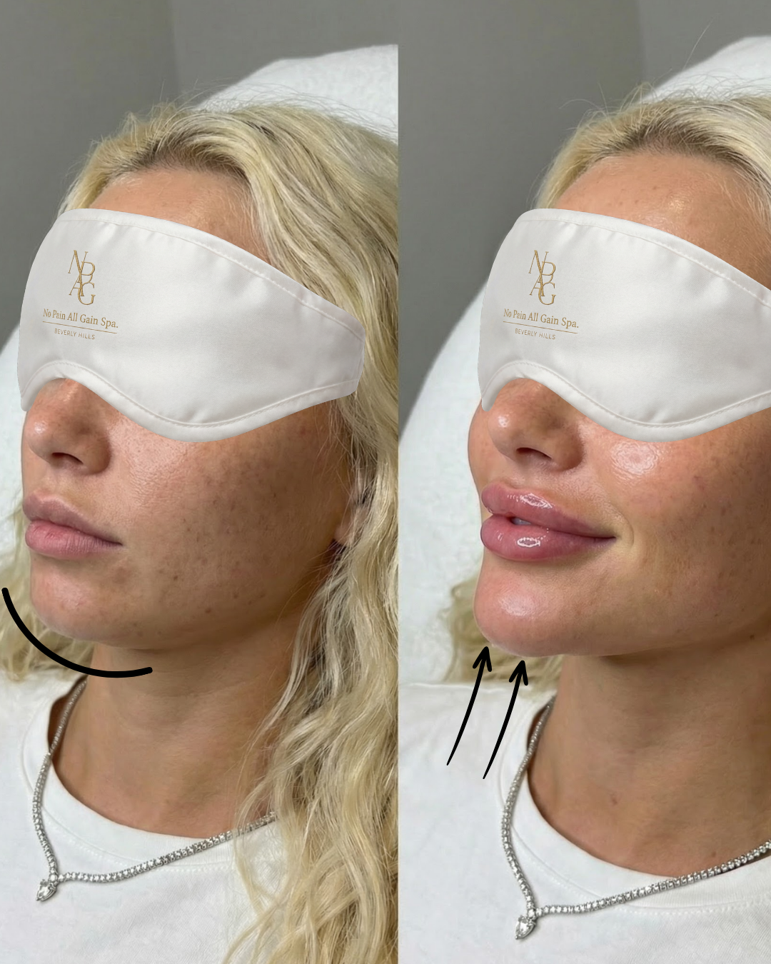 Side-by-side images of a woman's face before and after cosmetic lip enhancement, with a sleep mask covering her eyes in both images.