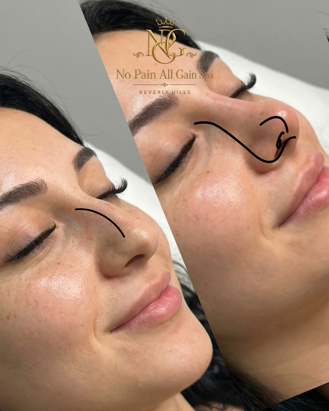 Side-by-side close-up of a woman's face showing before and after a nose treatment at No Pain All Gain Spa in Beverly Hills. The woman has dark hair, well-groomed eyebrows, and long eyelashes, with a natural complexion and slight freckles.