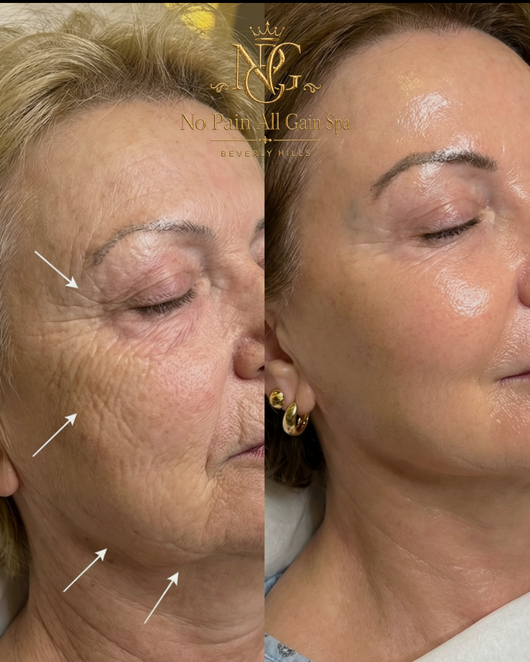 Side-by-side comparison of a woman's face before and after a skincare treatment, showing reduced wrinkles and improved skin texture.