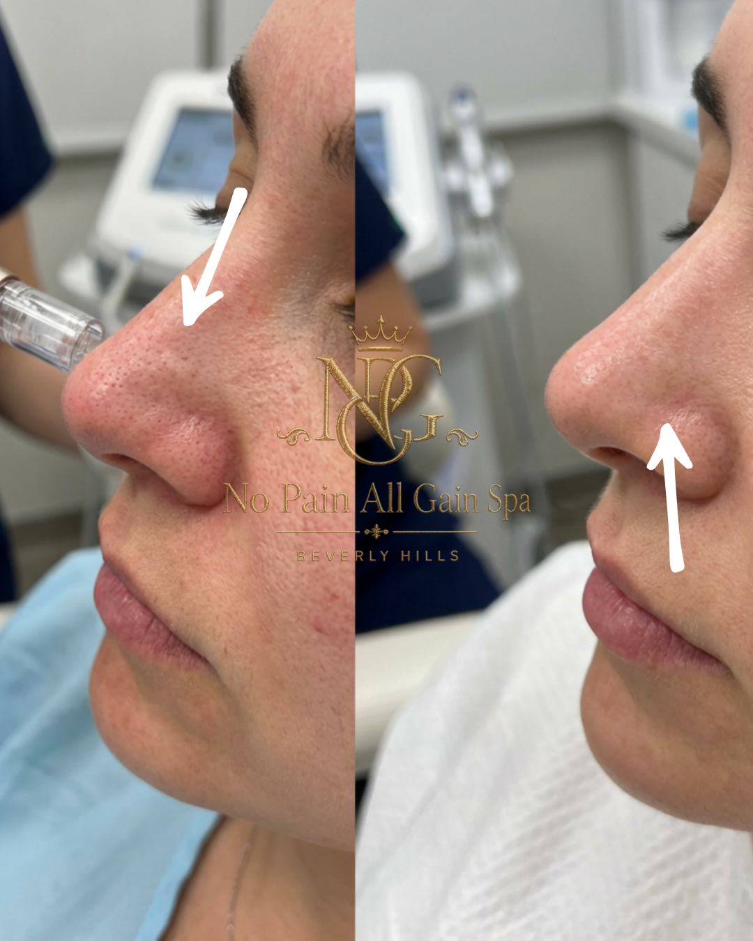 Before and after comparison of a woman's nose, showing skin improvement after a skincare treatment at No Pain All Gain Spa in Beverly Hills.
