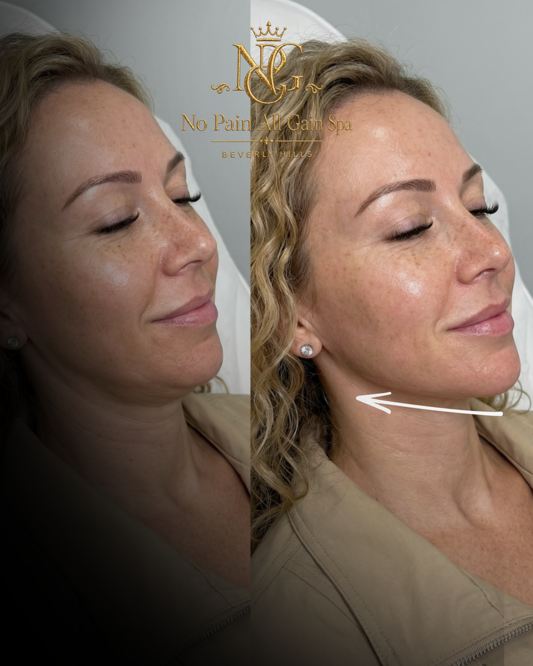 Side-by-side comparison of a woman's face before and after a facial treatment, showing improved skin texture and reduced pigmentation at No Pain All Gain Spa in Beverly Hills.