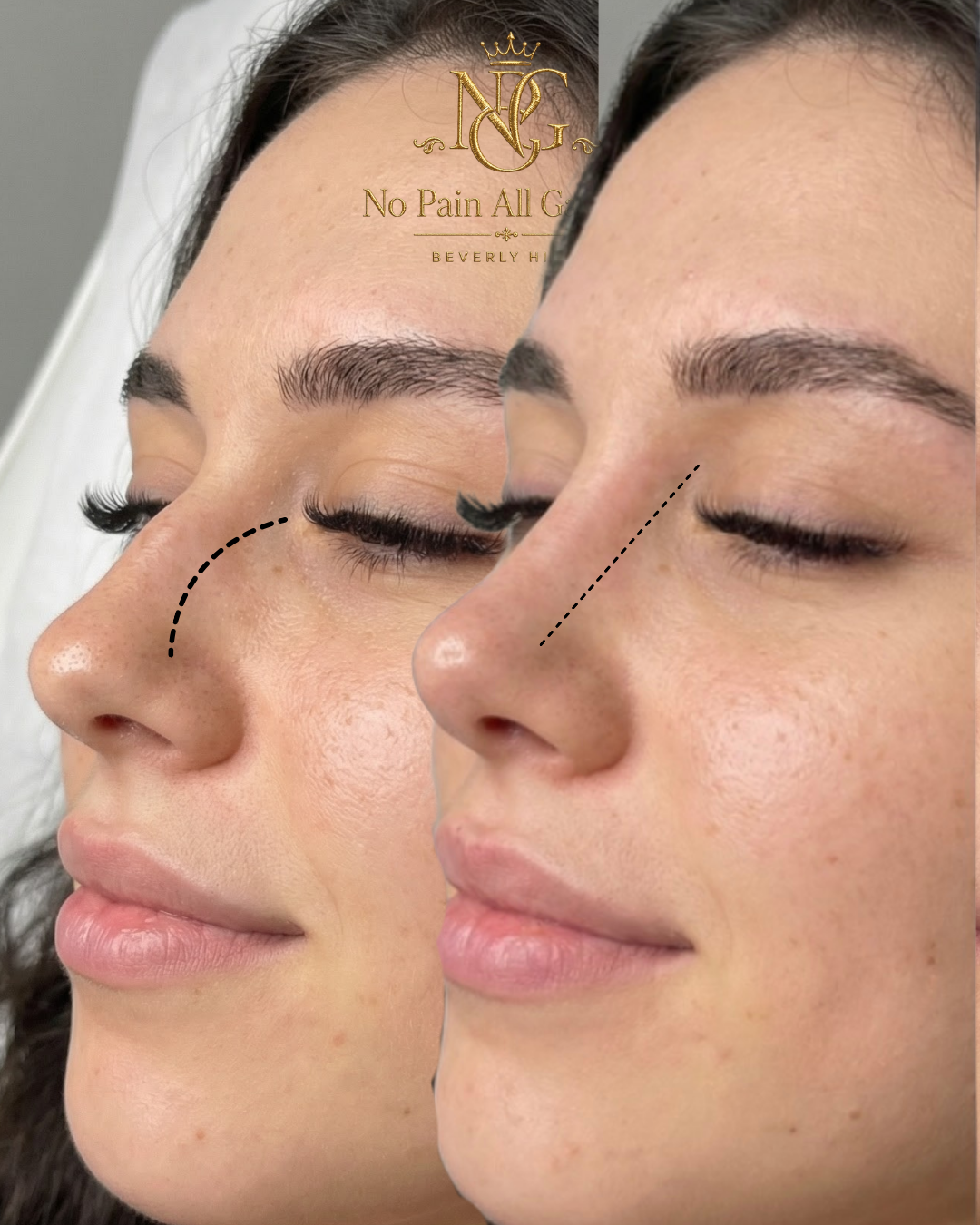 Close-up side view of a woman's face showing before-and-after results of a cosmetic procedure on the nose, with markings indicating the area treated.