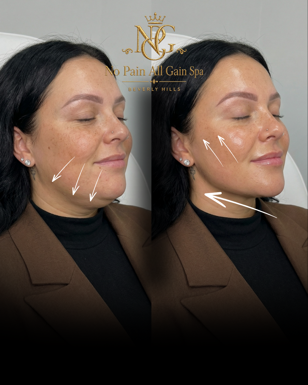 Side-by-side before and after photos of a woman showing skin improvement, with arrows pointing to areas on her cheek and jawline. Text overlay reads 'No Pain All Gain Spa Beverly Hills'.