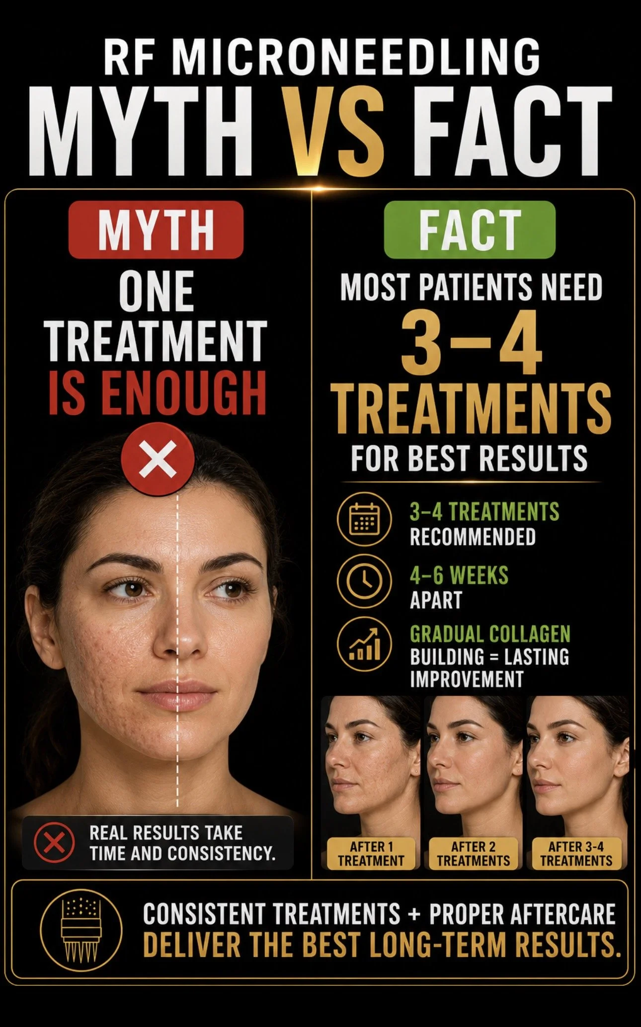 Comparison of acne results before and after RF microneedling treatments, showing a woman with acne on the left and clearer skin after multiple treatments on the right, along with text explaining treatment benefits and process.
