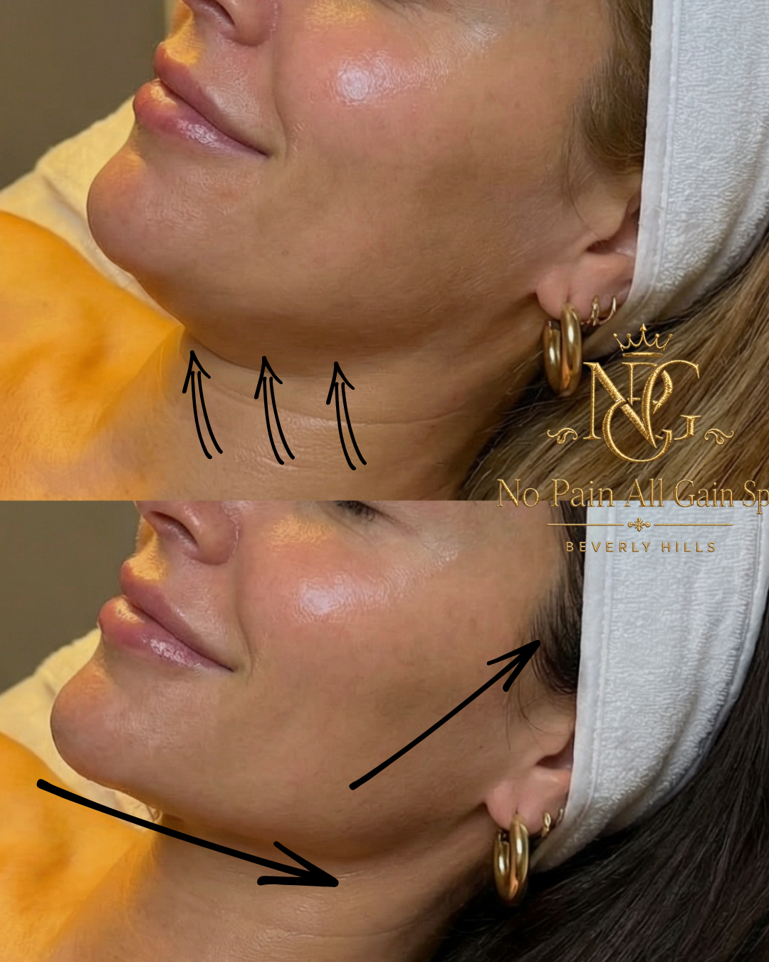 A woman’s face in two side-by-side photos, showing before and after a cosmetic procedure. In the first, she has natural skin with some lines, while in the second, her skin appears smoother and tighter. Black arrows indicate upward lifting of the jawl