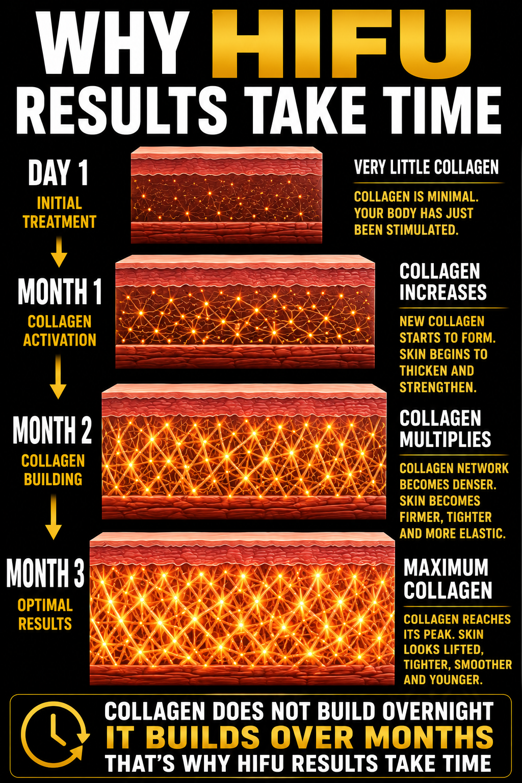 Diagram showing the process of collagen building in the skin over four months, highlighting stages from initial treatment, collagen activation, collagen multiplication, to maximum collagen, with descriptions of skin improvement over time.