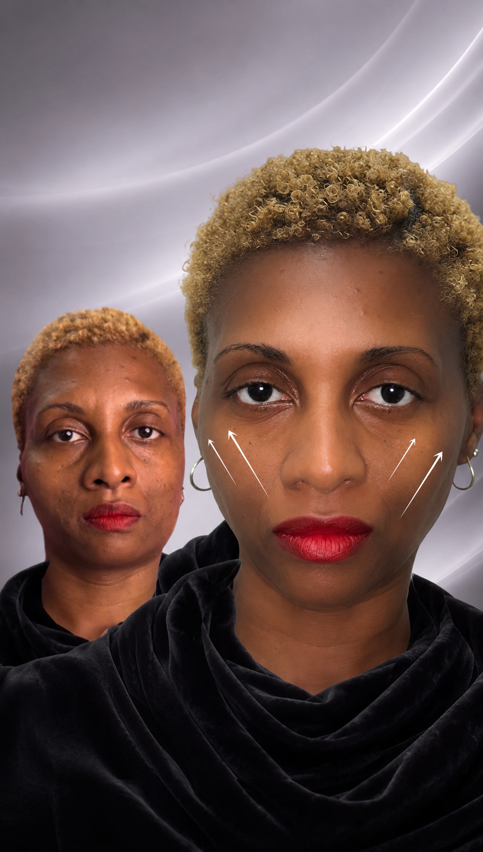 FULL FACE PDO THREAD LIFT BEFORE AND AFTER.