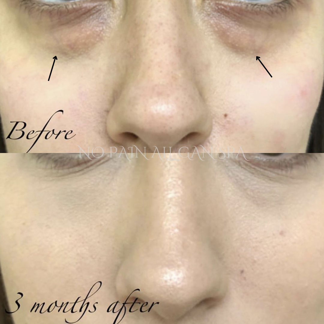 Comparison of a person's nose and cheek skin before and three months after skincare treatment, showing clear skin improvement.