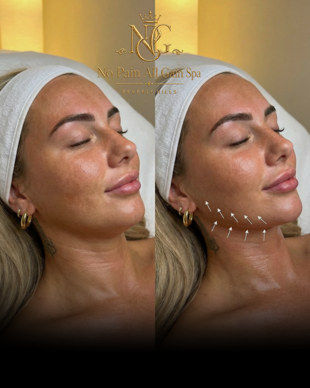 Side-by-side before and after images of a woman receiving a facial treatment at No Pain All Gain Spa, Beverly Hills, showing improved skin texture and lifting on the right side.