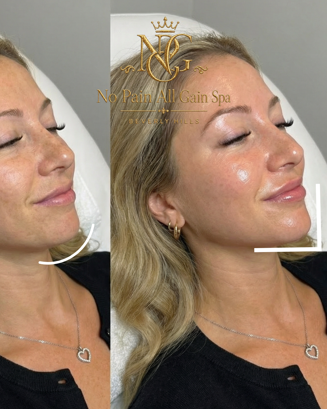 Side-by-side images of a woman with clear skin before and after skincare treatment, with text overlay for No Pain All Gain Spa in Beverly Hills.