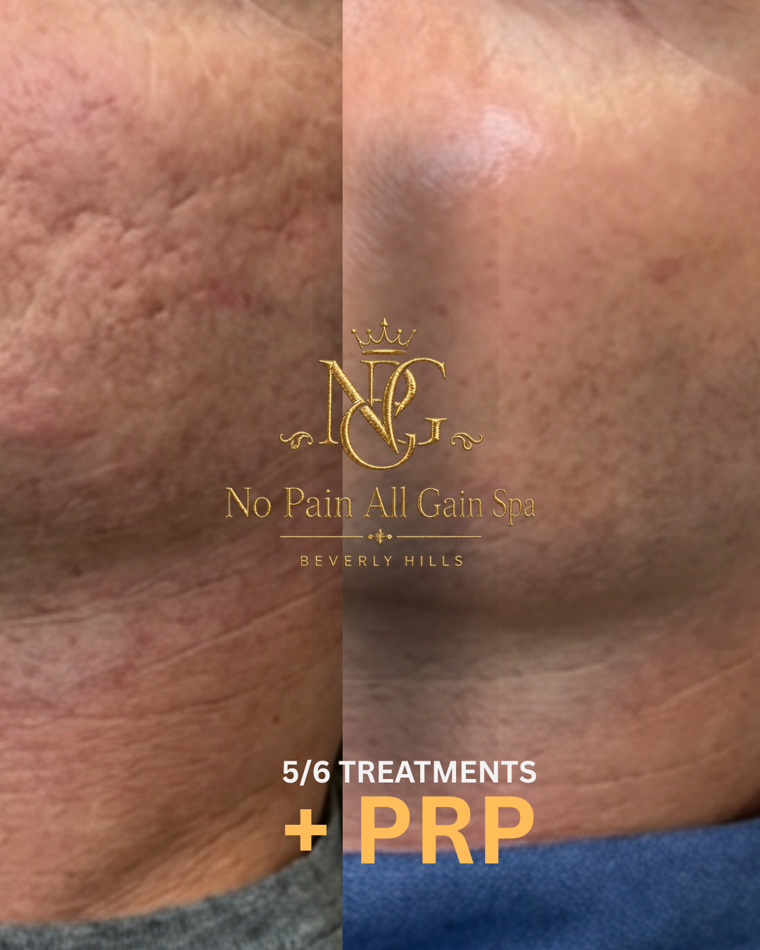 Side-by-side close-up images of skin showing improvement in skin texture and redness after treatment, with text overlay advertising a spa specializing in skin treatments, located in Beverly Hills, offering 5 to 6 treatments including PRP for skin rej
