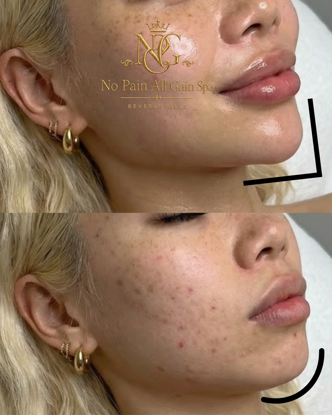 Close-up of a woman's face showing the before and after effects of skin treatment, focusing on her cheek and jawline, with the top image showing smoother skin and the bottom image showing acne and blemishes.