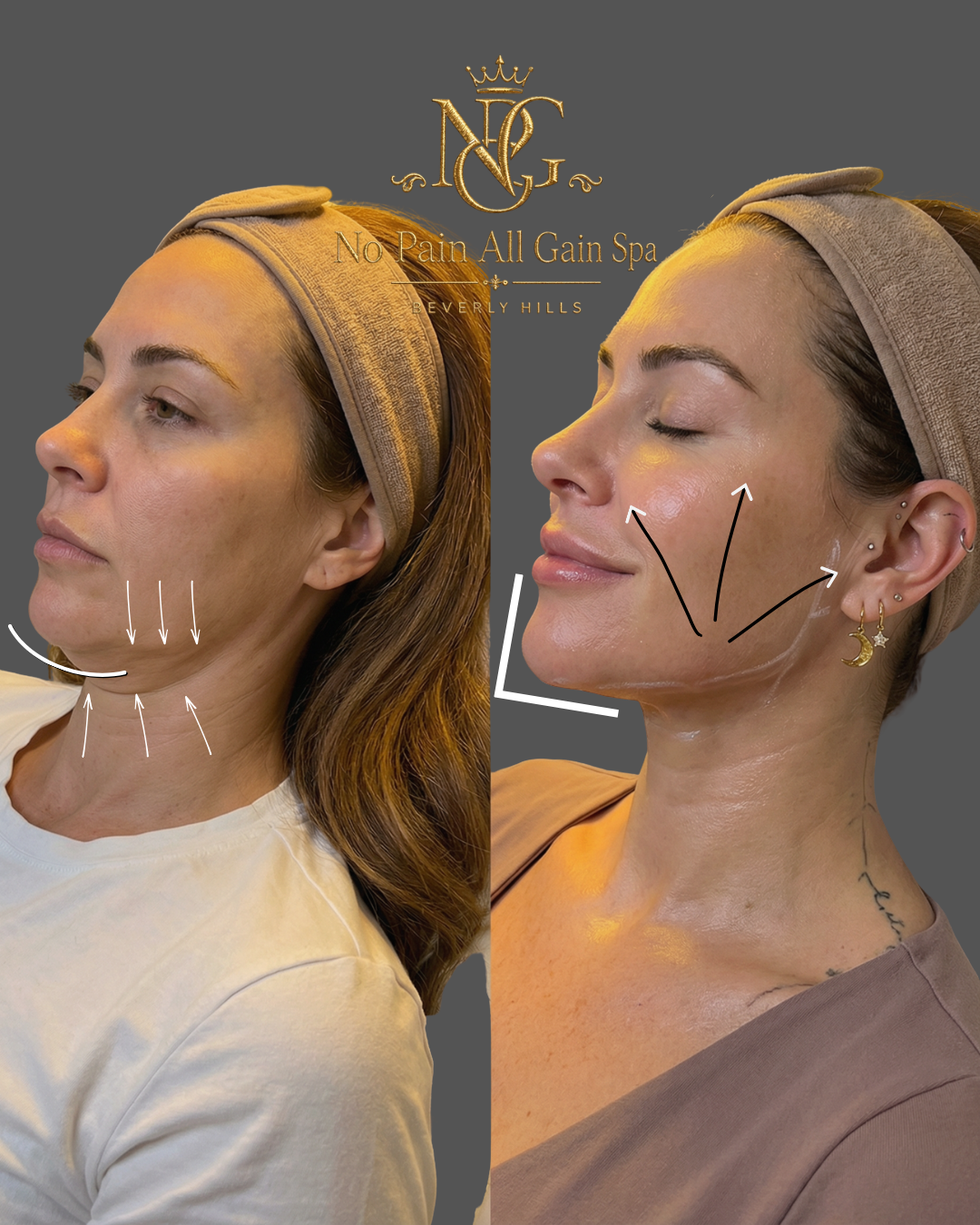 Before and after images of a woman receiving facial rejuvenation treatment at No Pain All Gain Spa in Beverly Hills. The left side shows her before the treatment, with arrows indicating areas of sagging skin on her chin and neck. The right side shows
