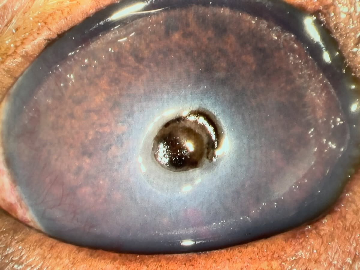 👁️ See that brown plaque? It was the clue we needed&hellip;

This deep corneal ulcer had us concerned, but the pigmented plaque made fungal keratitis jump to the top of our list. 🔬

Cytology delivered the answer: fungal hyphae. 🍄

The species wasn
