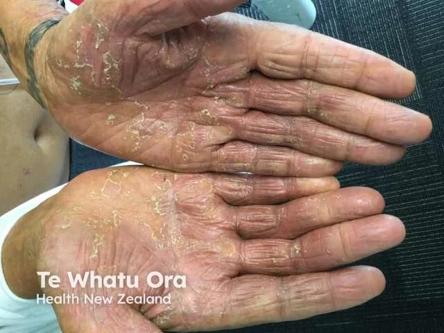 Hand Eczema Dryness
