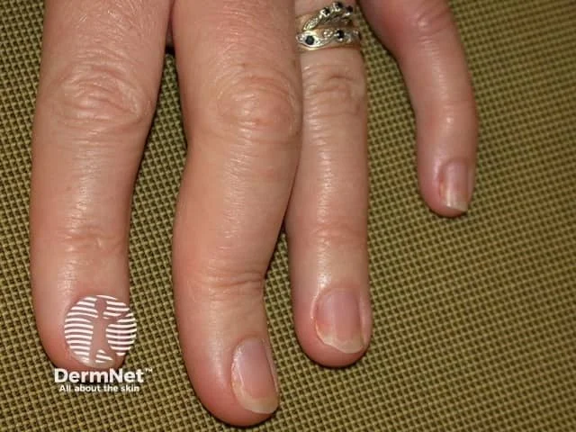 Psoriatic Arthritis Fingers