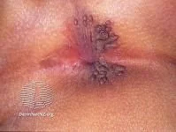 Genital warts around the anus