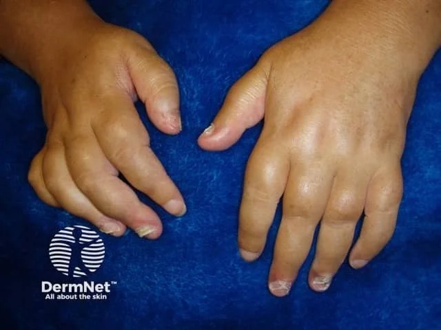 Psoriatic arthritis swollen fingers