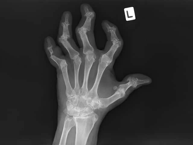 Psoriatic arthritis Xray hands