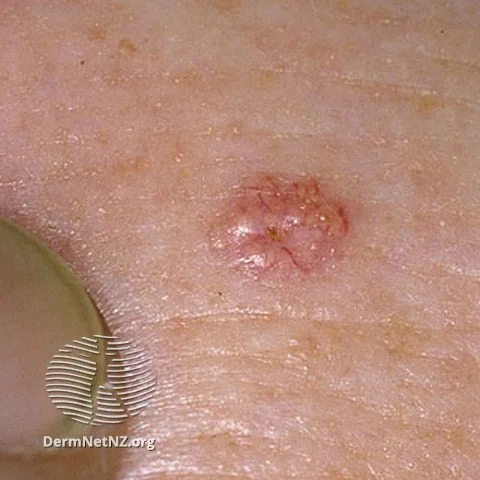 Sebaceous hyperplasia sometimes can resemble basal cell carcinoma.