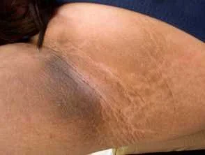 An example of how acanthosis nigricans can appear on the armpit