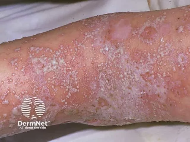 Generalized pustular psoriasis extremities