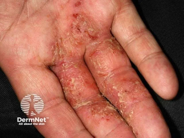 Hand Eczema Fingers