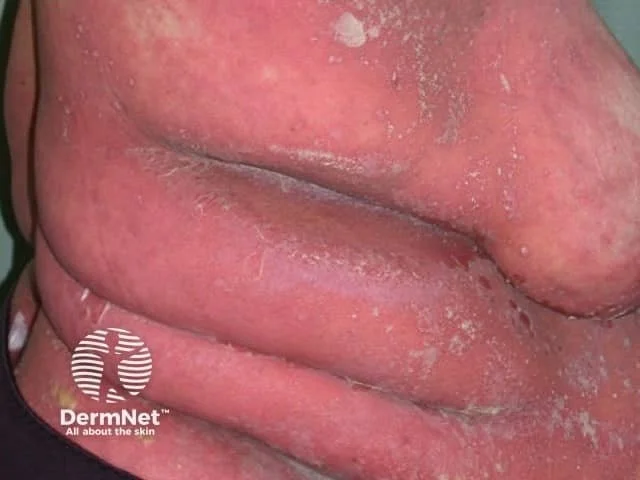 Generalized pustular psoriasis erythroderma