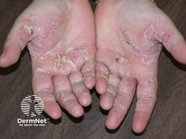Hand Eczema Treatment