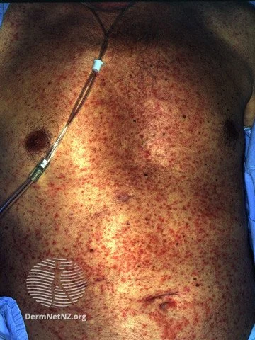 DRESS Syndrome Rash