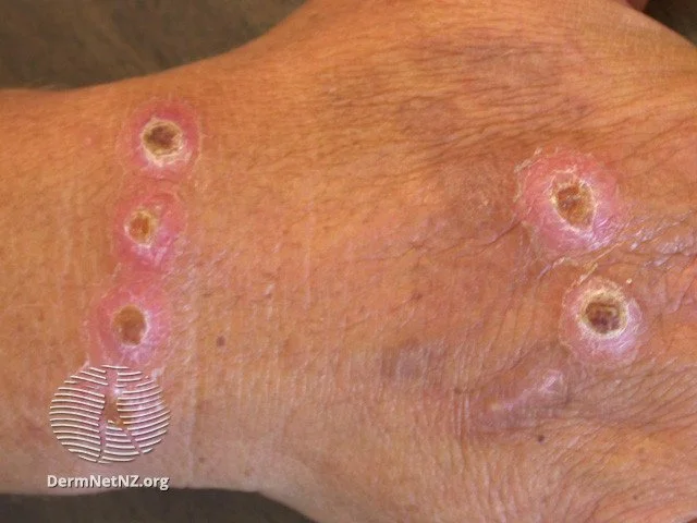 Burns from a cigarette