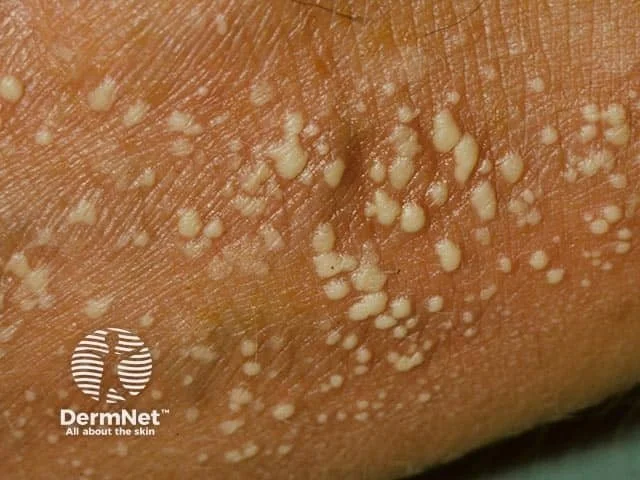 Generalized pustular psoriasis pustules