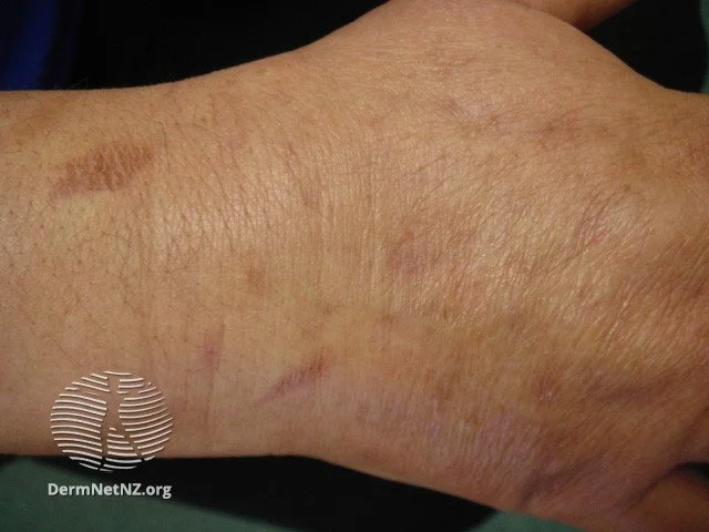 Post inflammatory hyperpigmentation from a resolving oven burn.