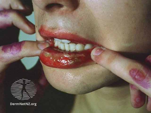 Mucosal involvement of Erythema Multiforme