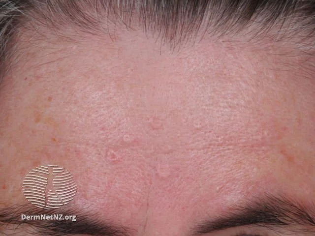Sebaceous hyperplasia on the forehead can look like pimple-type bumps that don't go away.