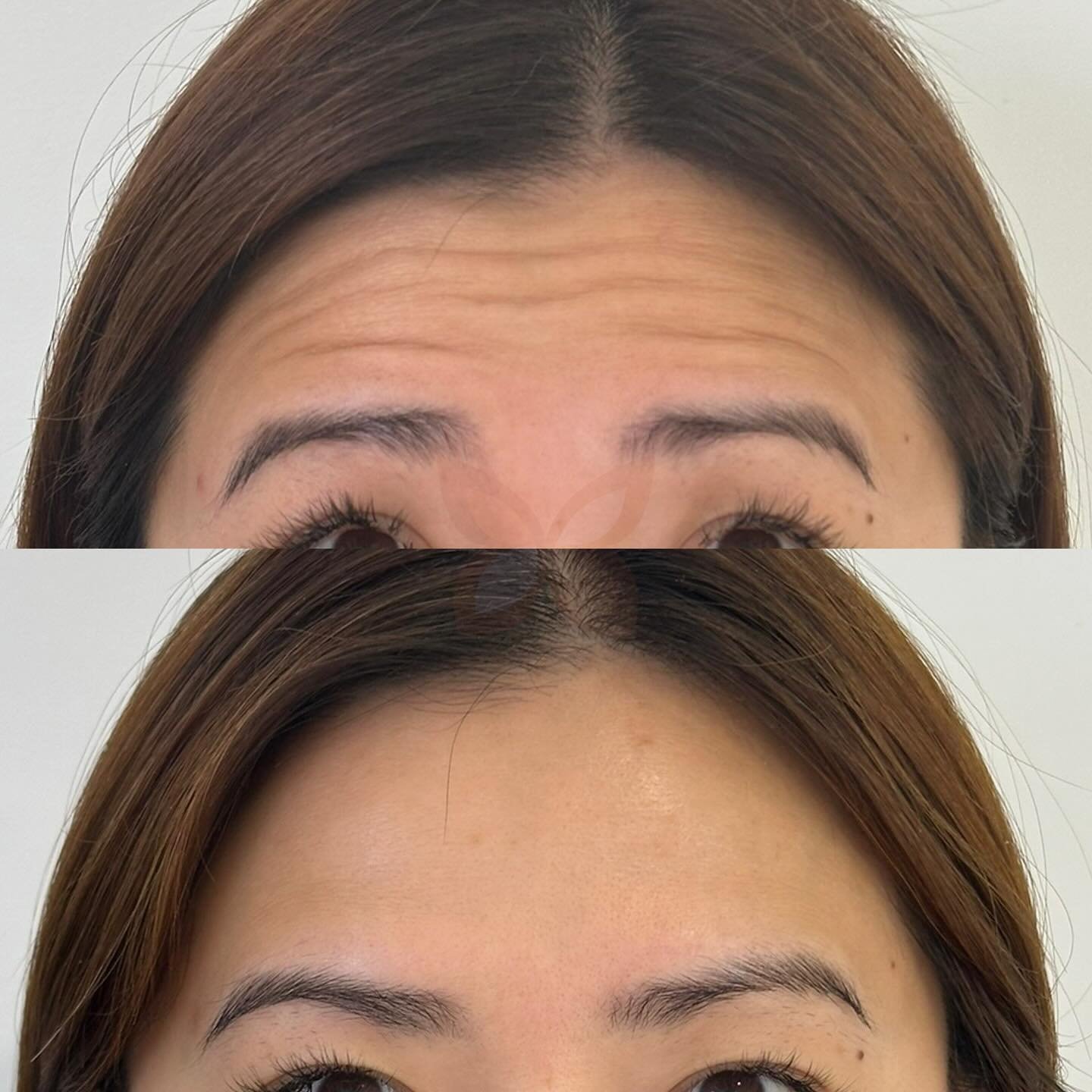 Long time no post! Have so many amazing beautiful natural results before and after photos that i need to start posting ✨

Thank you for allowing me to share these x

Forehead and frown lines treated, before and after two weeks apart!
(Also did crows,