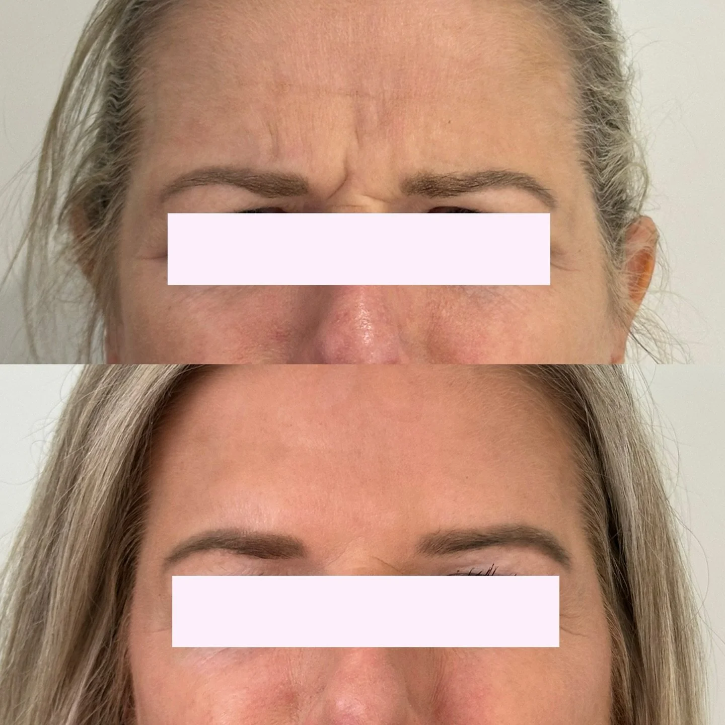 Frown and forehead treatment 2 weeks post 🙌

Make sure to book in your October/ November appointment, im slowing getting booked up around that time😊!
Its often our busiest period, so don&rsquo;t want you to miss out!
And if you have been thinking a