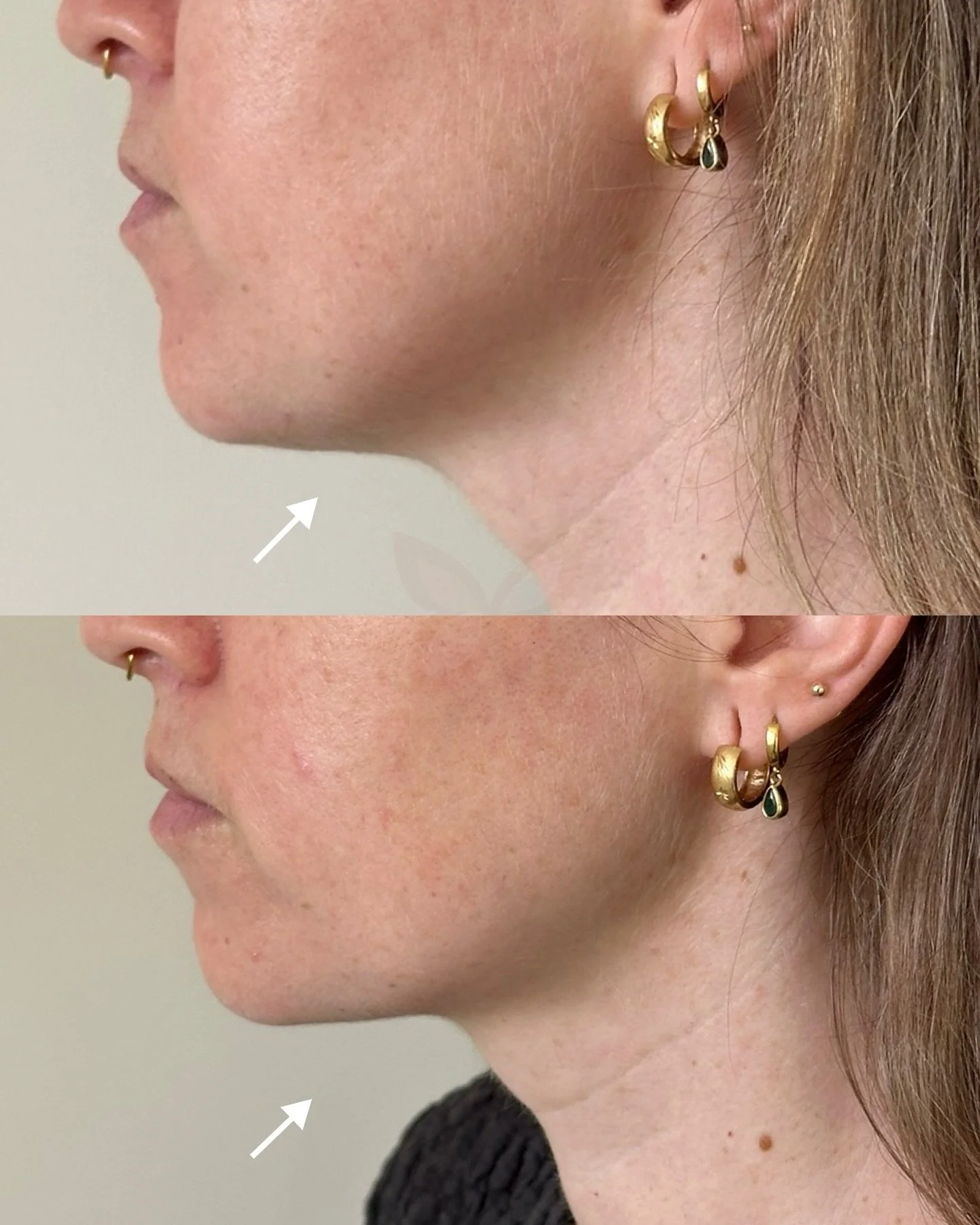 Introducing our newest on- label treatment: the Nefertiti band✨

This non surgical treatment works by the neck platysma muscle to:
- soften the appearance if a double chin
- smooth neck lines and bands
- sharpen and define the jawline
- gently lift t