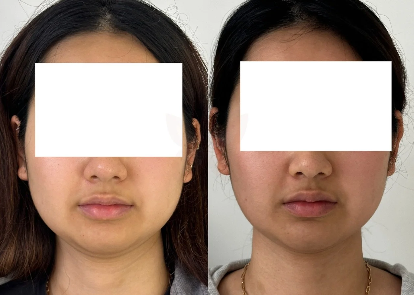 Platysmal treatment ✨

Also combining other area of tox treatment (not gonna mention it there, but you are keen! Book in for a consultation and we can chat more)

One month before and after.

Less heavy on the lower face, more defined jawline! We lov