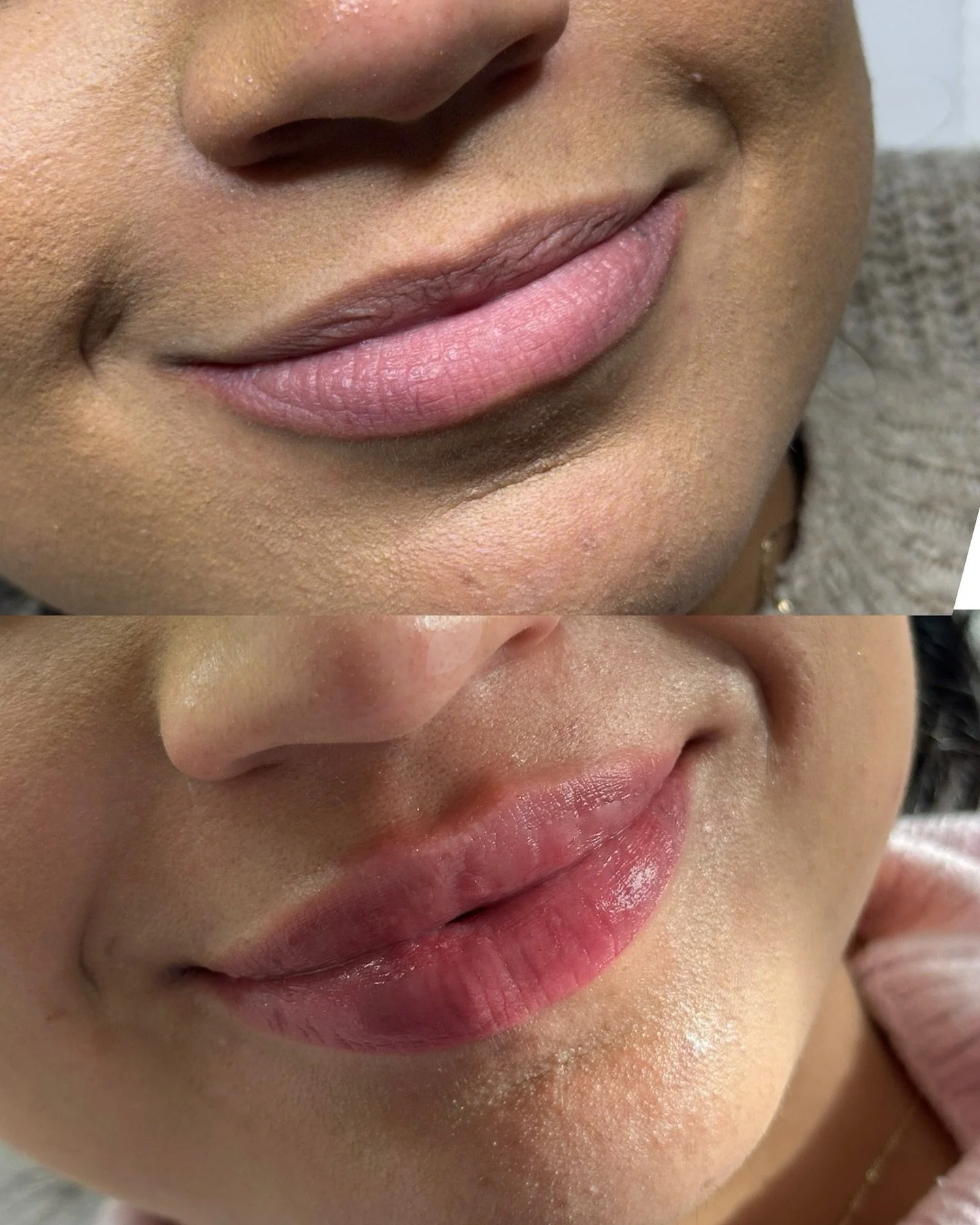 1ml before and after lip filler 🙌

Completed the treatment in two sessions x 2 weeks apart!

✨Pre-Lip Filler Treatment Guidelines
To achieve the best results and minimise swelling or bruising, please prepare as follows before your appointment:

1.）A
