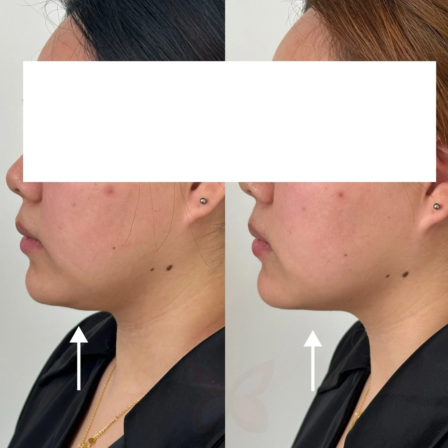 Another amazing result with playtsmal band😍
Two weeks before and after!

Client also had another area treated (one of the best combo 💉), if you are interested in what it is, book in for a consultation or message me!

&mdash;&mdash;&mdash;&mdash;&md