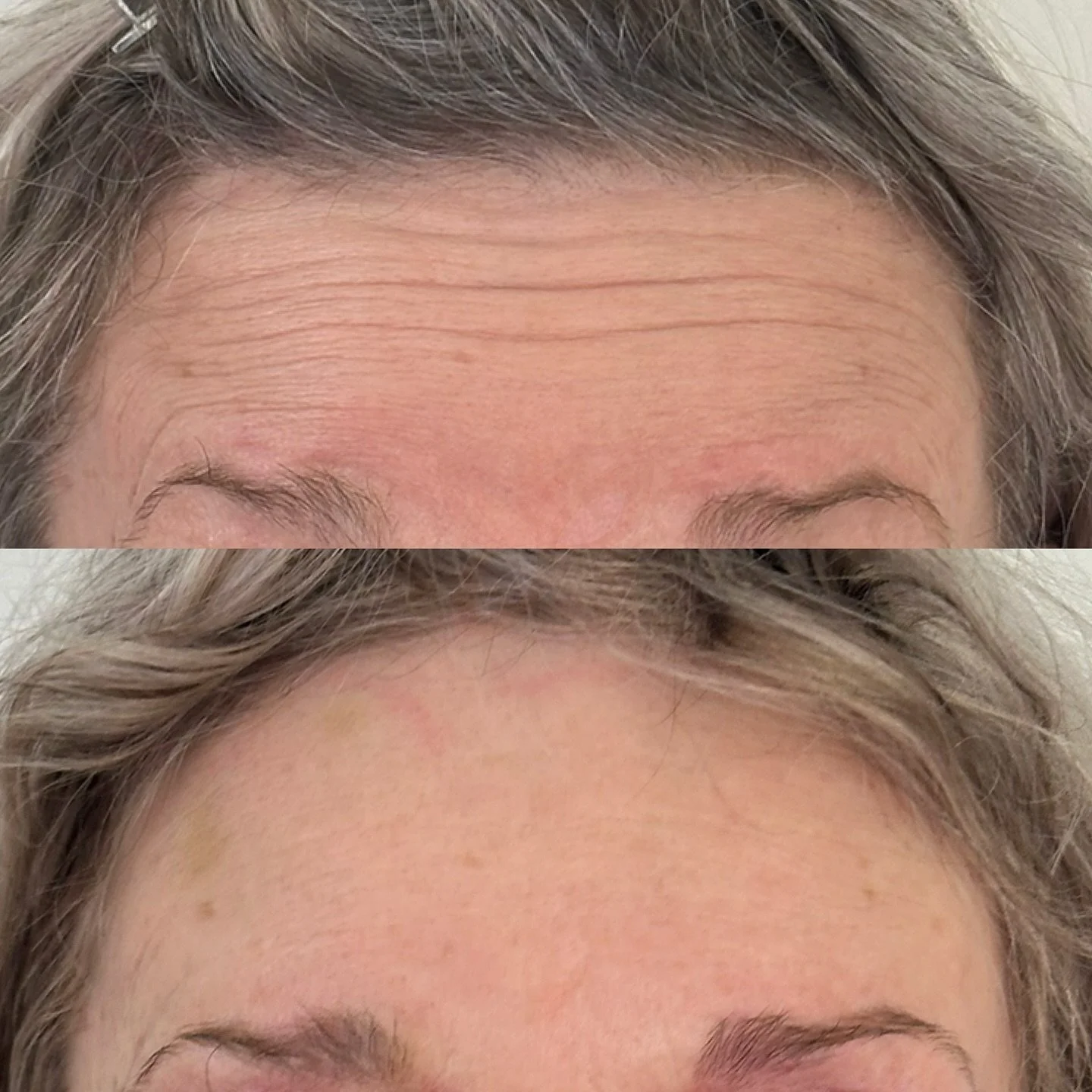 Antiwrinkles treatment before and after

Thank you for allowing me to share this ☺️ getting very close to Christmas time, please make sure to book in your injectables appointment early! (I can&rsquo;t believe I&rsquo;m booking my October Client for 2