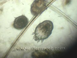 norwegscabies2.jpeg