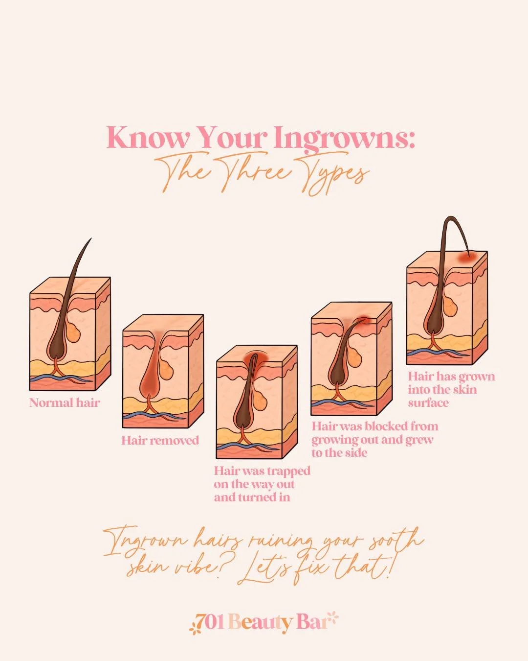Let's talk about those pesky bumps that can show up after any kind of hair removal 🔍 Not all ingrown hairs are created equal! Understanding WHAT type you're dealing with makes all the difference in how to treat (and prevent) them. Here are the three