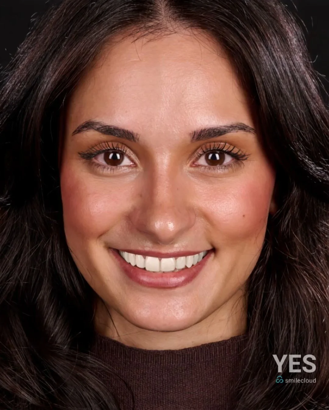 Smile Design Example